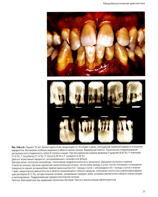 Лечение пародонтита тяжелой степени