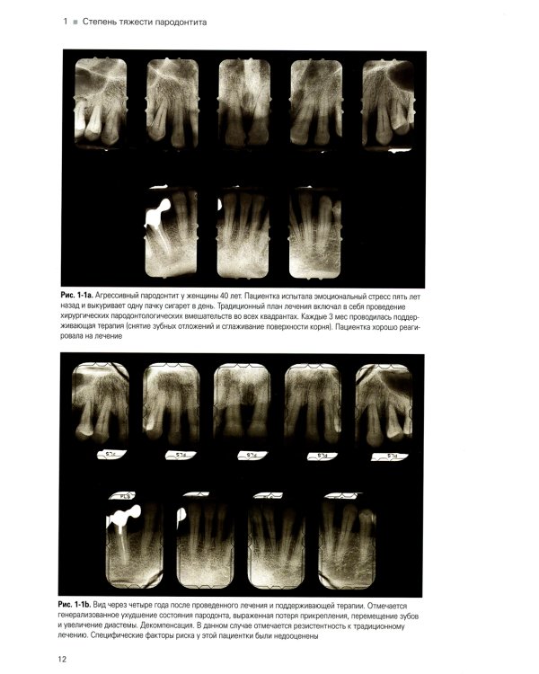 Лечение пародонтита тяжелой степени