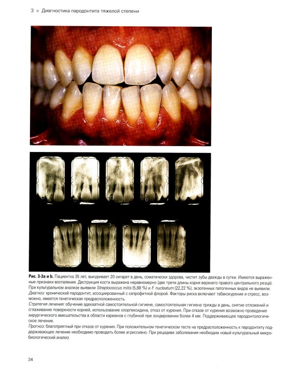 Лечение пародонтита тяжелой степени