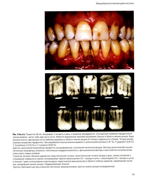 Лечение пародонтита тяжелой степени