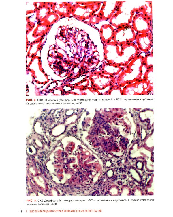 Биопсийная диагностика ревматических заболеваний. Руководство для врачей