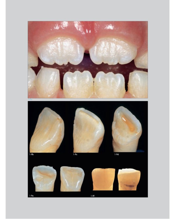 Адгезивные керамические реставрации передних зубов. 4-е изд
