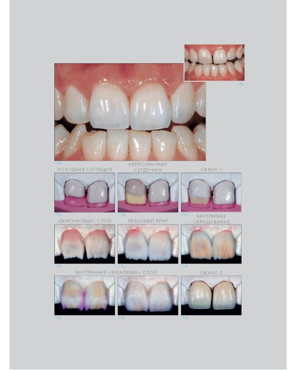Адгезивные керамические реставрации передних зубов. 4-е изд
