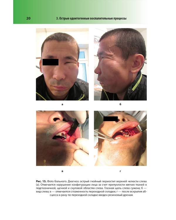 Абсцессы и флегмоны челюстно-лицевой области и шеи. Атлас: учебное пособие