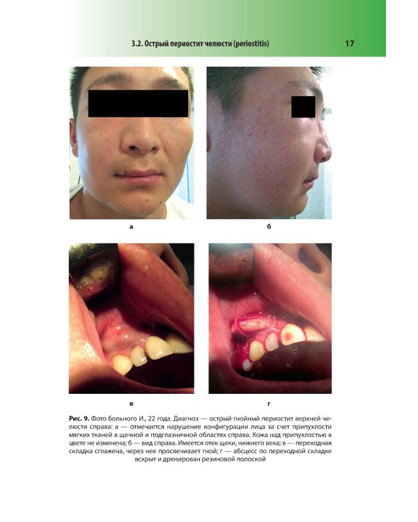 Абсцессы и флегмоны челюстно-лицевой области и шеи. Атлас: учебное пособие