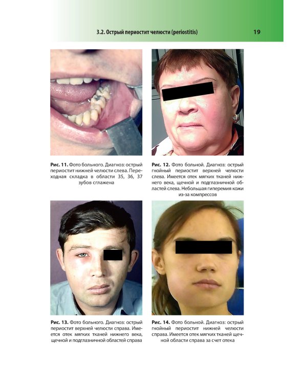 Абсцессы и флегмоны челюстно-лицевой области и шеи. Атлас: учебное пособие