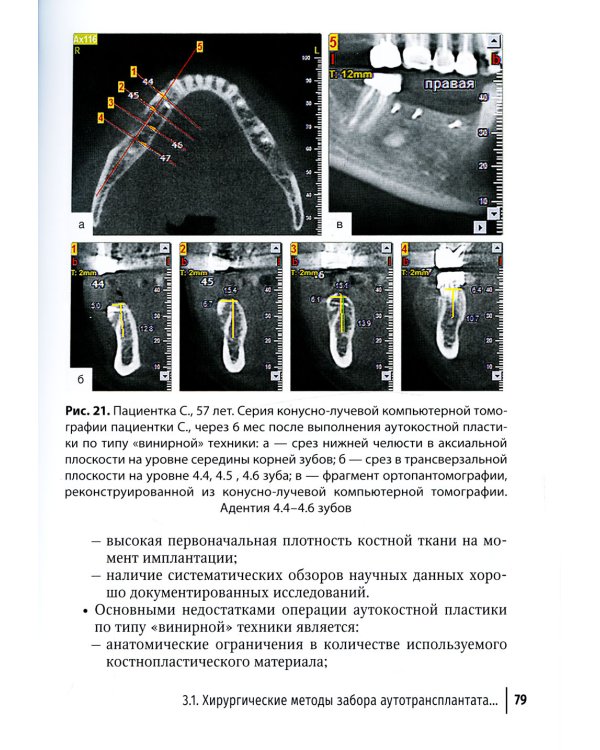 Костная пластика перед выполнением дентальной имплантации: Учебное пособие