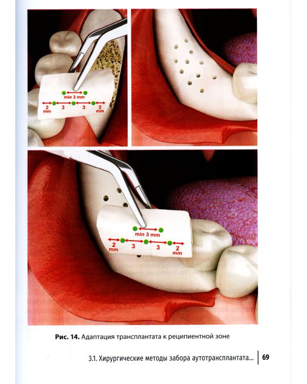 Костная пластика перед выполнением дентальной имплантации: Учебное пособие