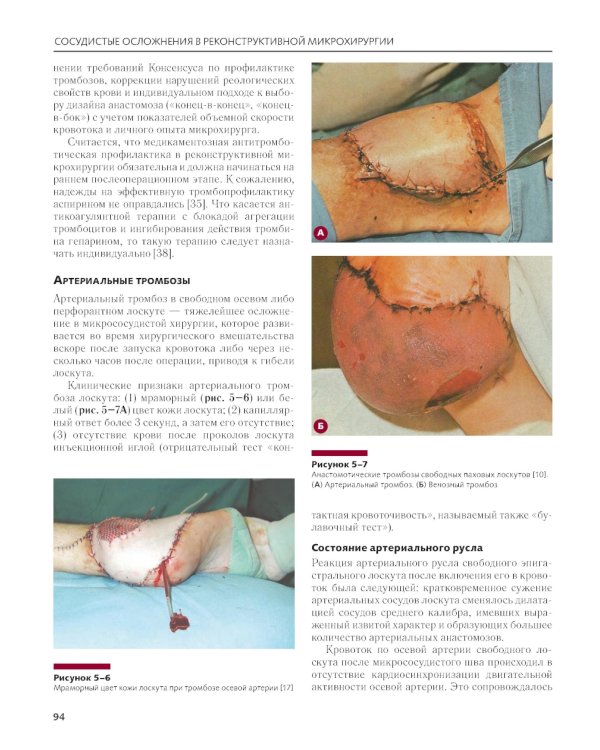 Сосудистые осложнения в реконструктивной микрохирургии