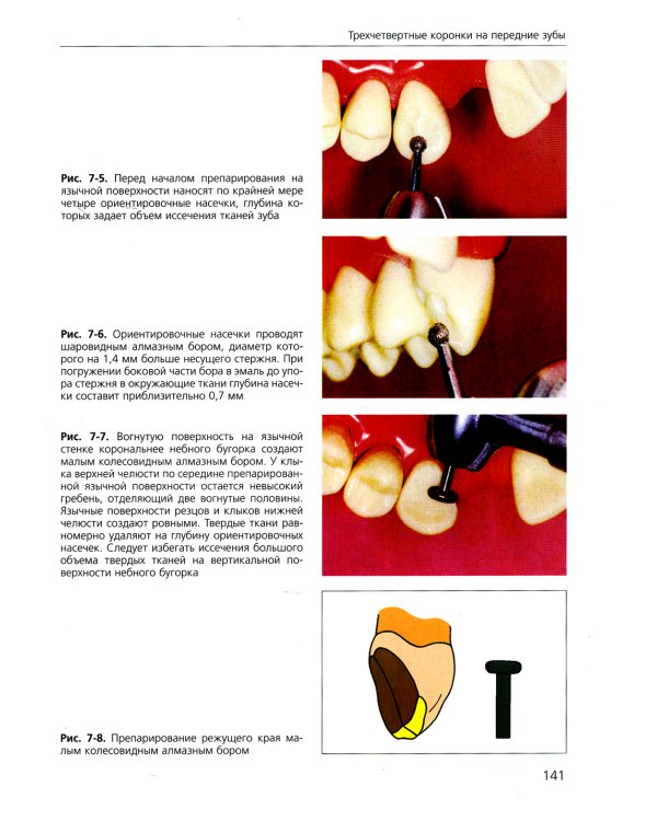 Основы препарирования зубов. Для изготовления литых металлических и керамических реставраций