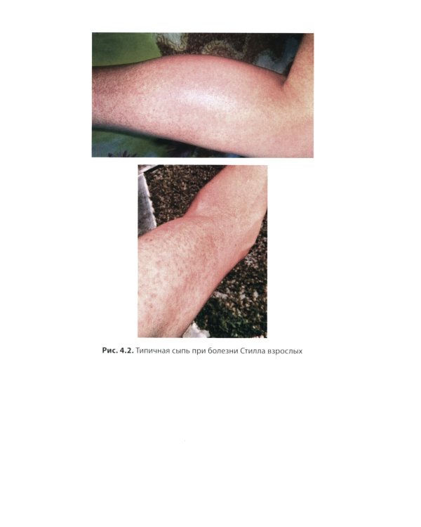 Ревматоидный артрит: руководство для врачей. 2-е изд., перераб. и доп