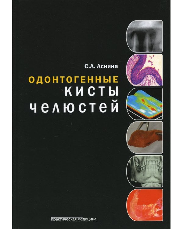 Одонтогенные кисты челюстей