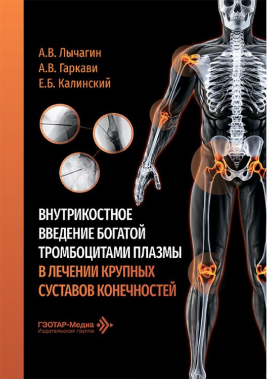 Внутрикостное введение богатой тромбоцитами плазмы в лечении крупных суставов конечностей