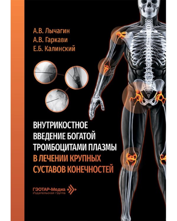Внутрикостное введение богатой тромбоцитами плазмы в лечении крупных суставов конечностей