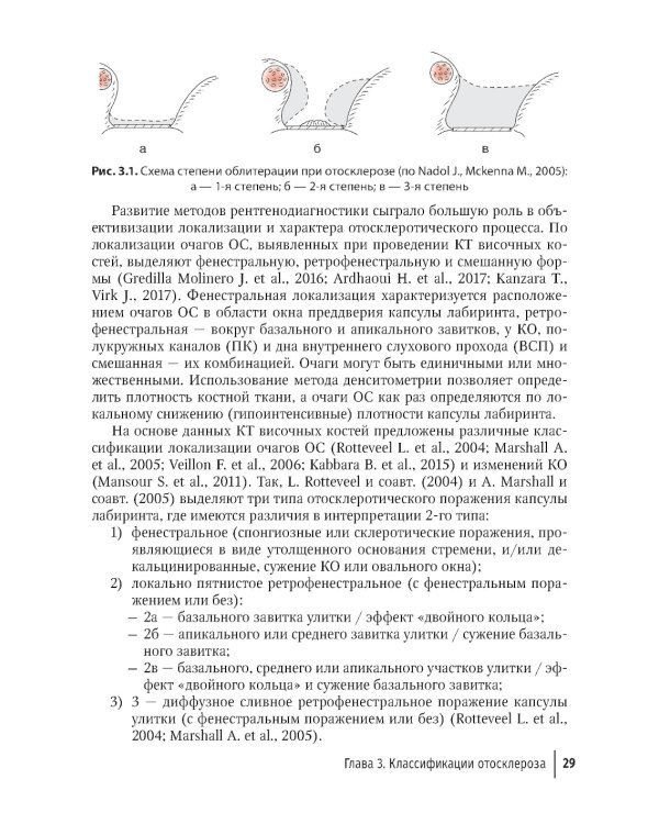 Отосклероз