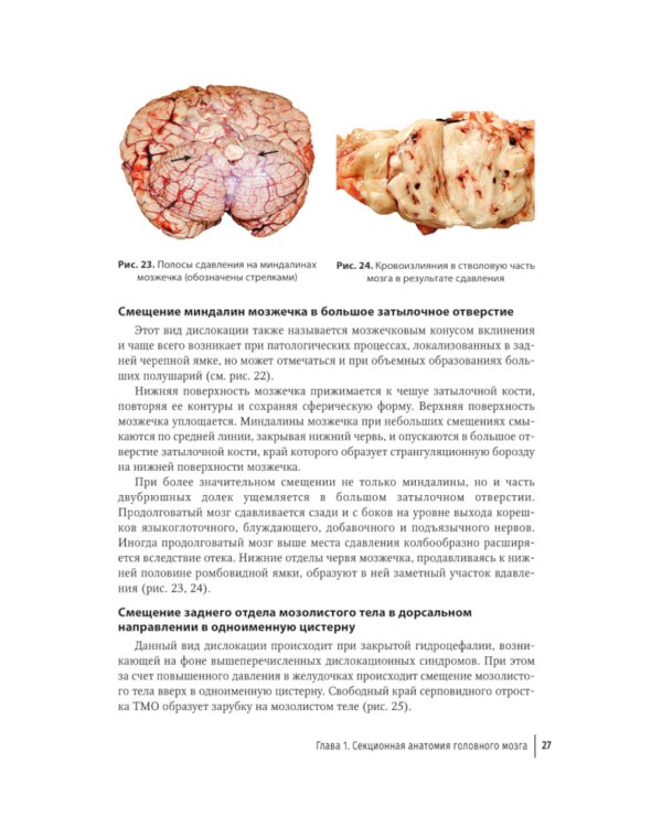 Судебная невропатология. Черепно-мозговая и спинальная травмы: руководство для врачей