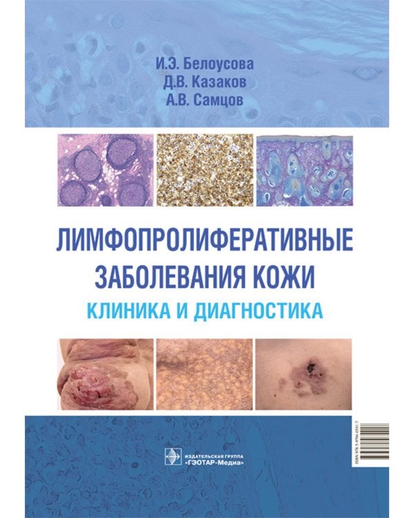 Лимфопролиферативные заболевания кожи. Клиника и диагностика