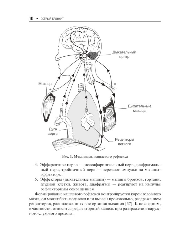 Острый бронхит