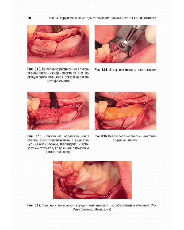 Костная пластика перед дентальной имплантацией: Учебное пособие