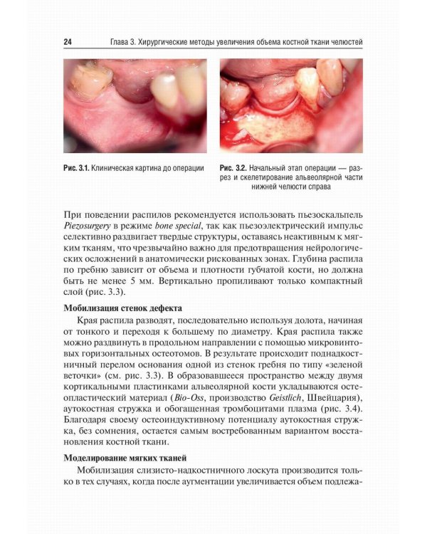 Костная пластика перед дентальной имплантацией: Учебное пособие