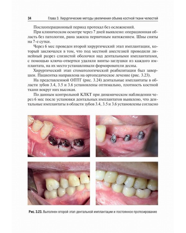Костная пластика перед дентальной имплантацией: Учебное пособие