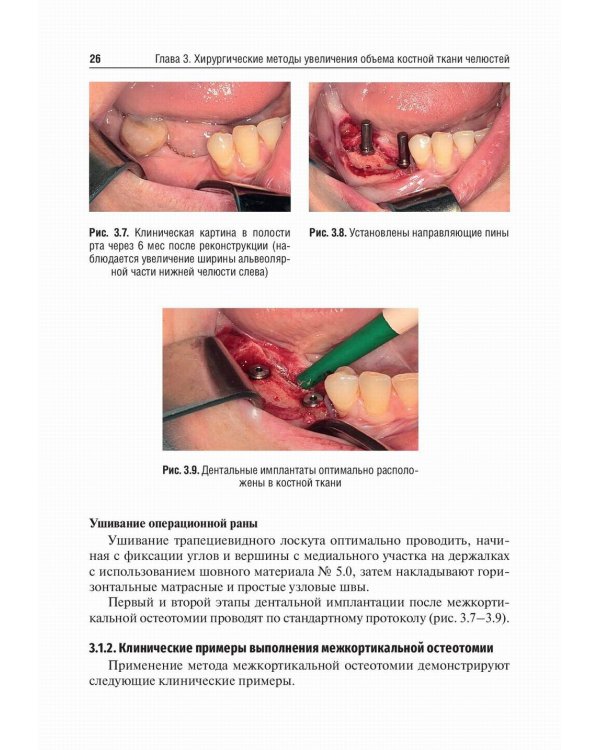Костная пластика перед дентальной имплантацией: Учебное пособие