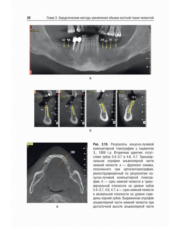 Костная пластика перед дентальной имплантацией: Учебное пособие