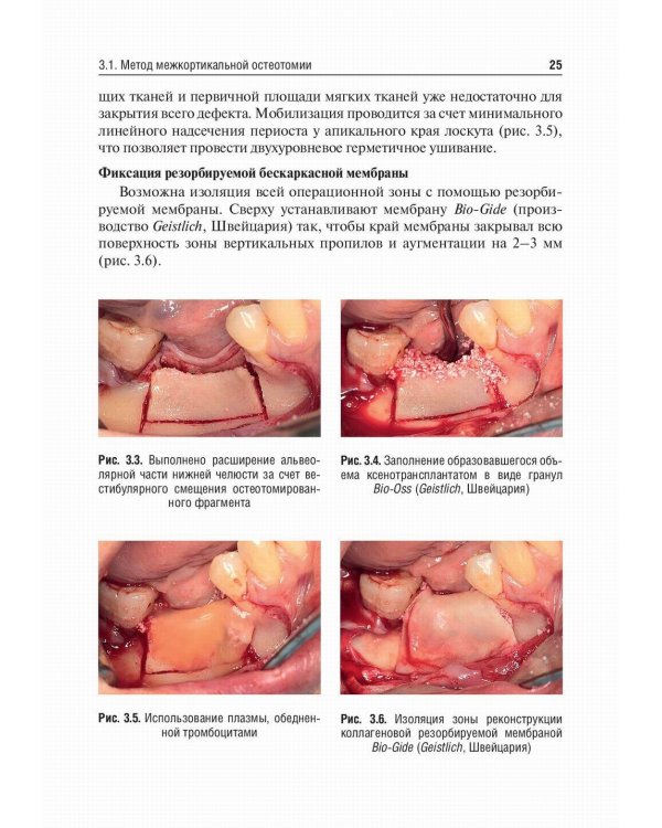 Костная пластика перед дентальной имплантацией: Учебное пособие