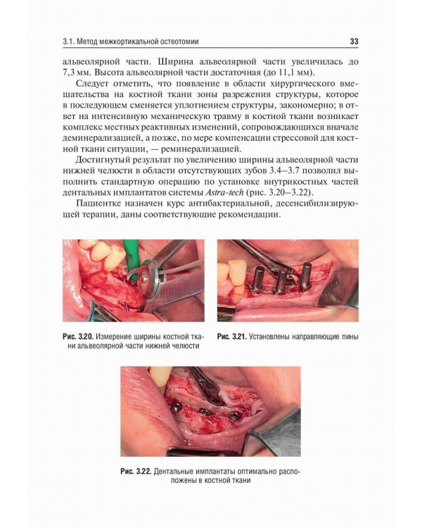 Костная пластика перед дентальной имплантацией: Учебное пособие