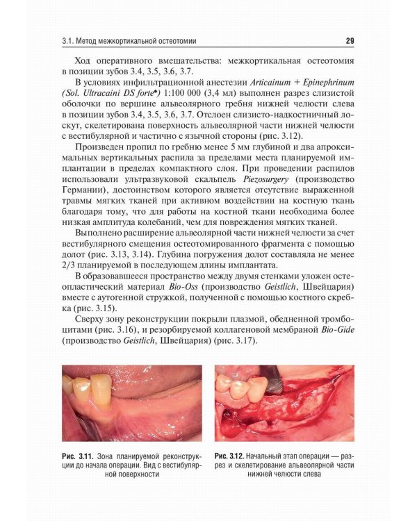 Костная пластика перед дентальной имплантацией: Учебное пособие
