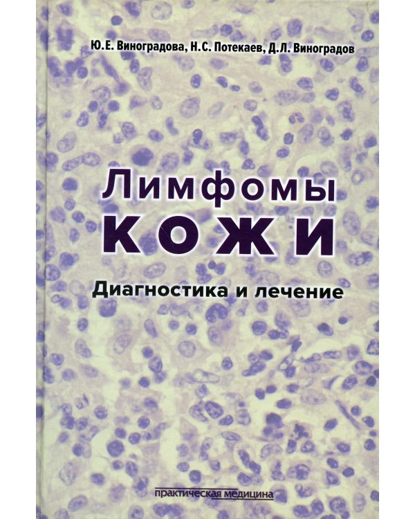 Лимфомы кожи: Диагностика и лечение