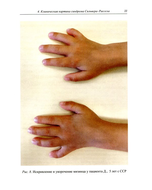 Синдром Сильвера-Рассела: клиника, диагностика, лечение: Учебно-методическое пособие