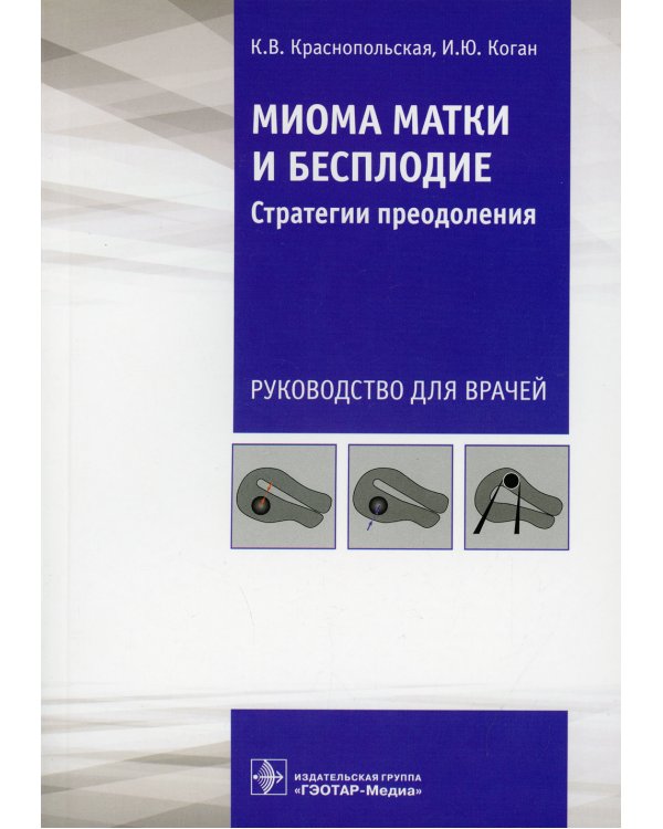 Миома матки и бесплодие: стратегии преодоления: руководство для врачей