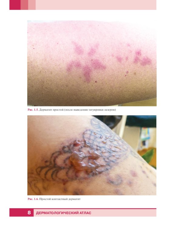 Дерматологический атлас. 2-е изд., доп