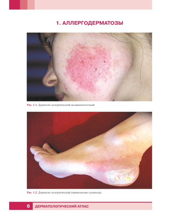 Дерматологический атлас. 2-е изд., доп