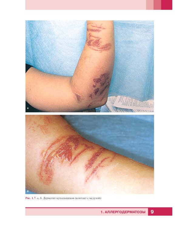 Дерматологический атлас. 2-е изд., доп