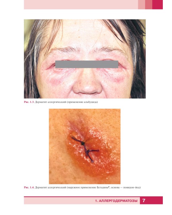 Дерматологический атлас. 2-е изд., доп