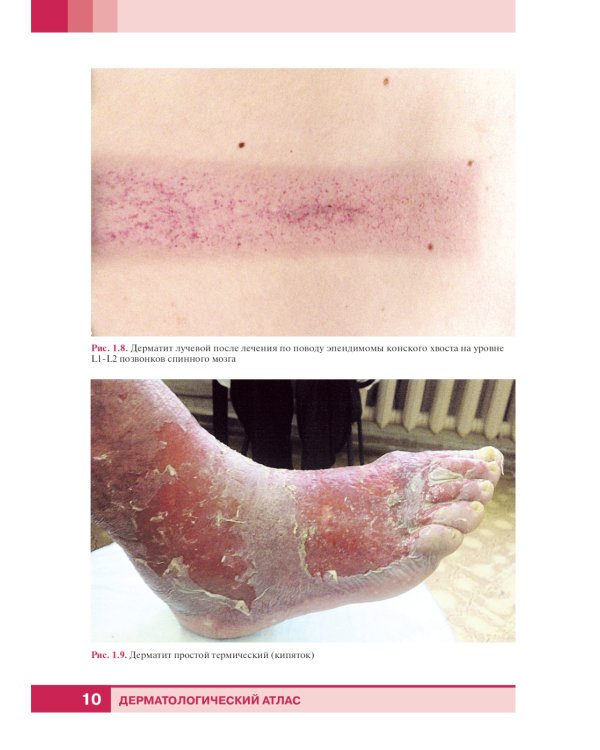 Дерматологический атлас. 2-е изд., доп