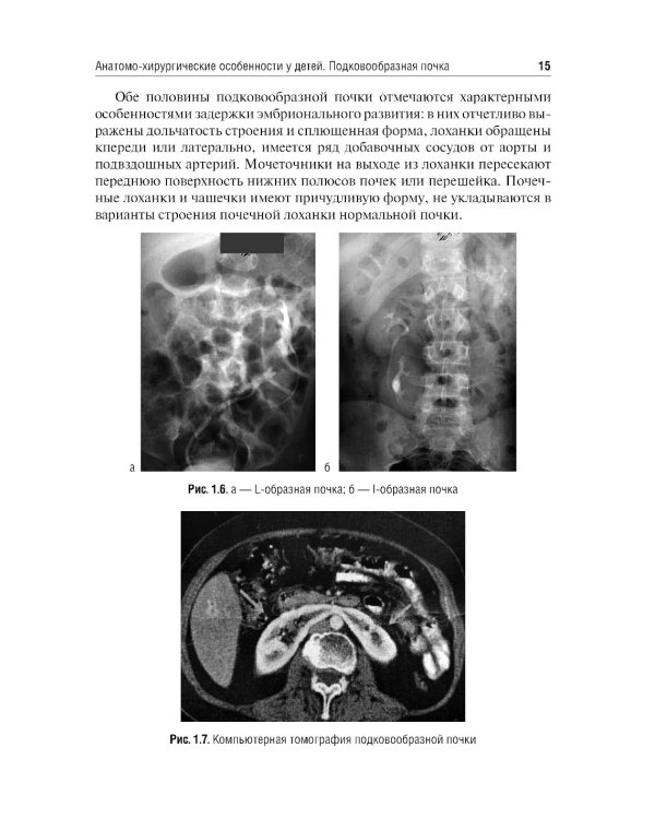Хирургия подковообразных почек в детском возрасте: Учебное пособие