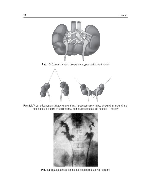 Хирургия подковообразных почек в детском возрасте: Учебное пособие