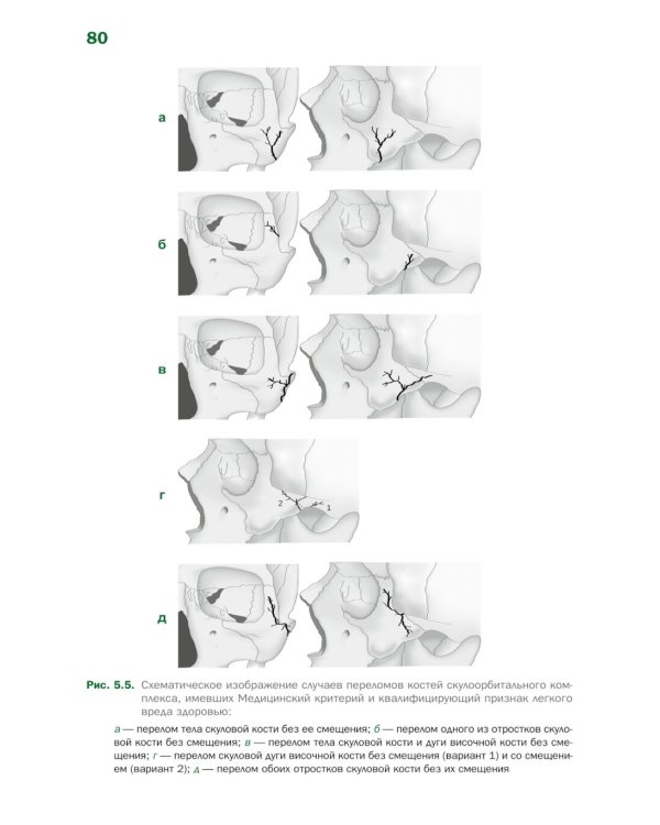Судебно-медицинская оценка тяжести вреда здоровью при переломах костей скулоорбитального комплекса: монография