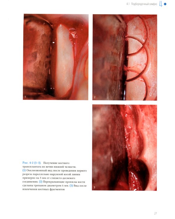 Увеличение высоты и толщины альвеолярного гребня. Перспективы
