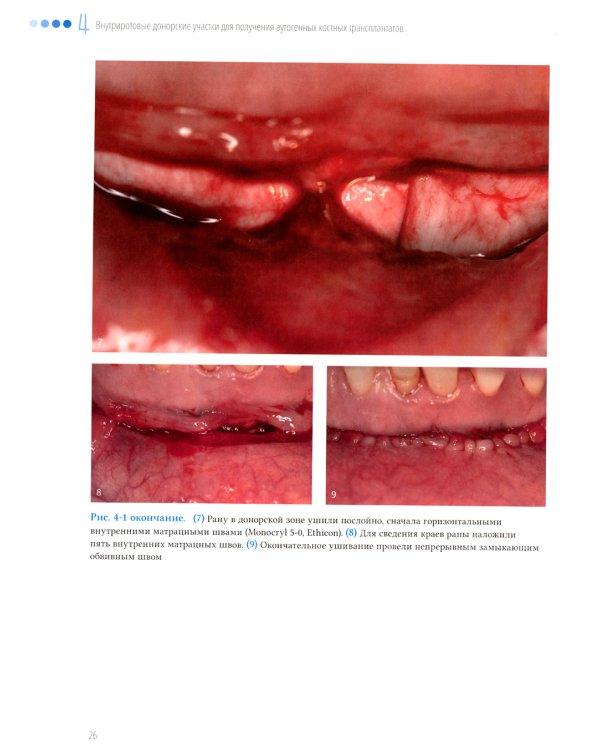 Увеличение высоты и толщины альвеолярного гребня. Перспективы