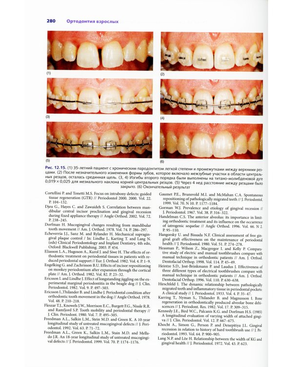 Ортодонтия взрослых