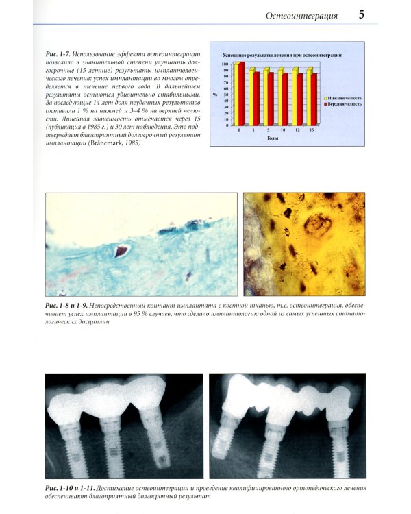 Устранение осложнений имплантологического лечения