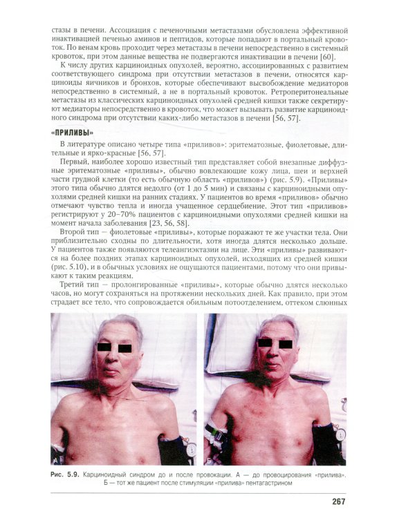 Полиэндокринопатии и паранеопластические синдромы