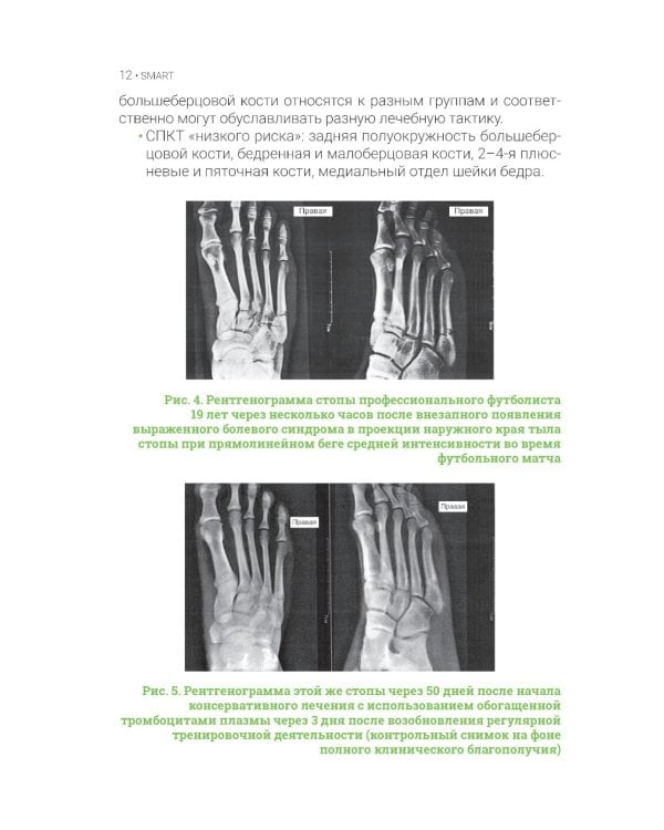 Стрессовые повреждения костной ткани в спорте
