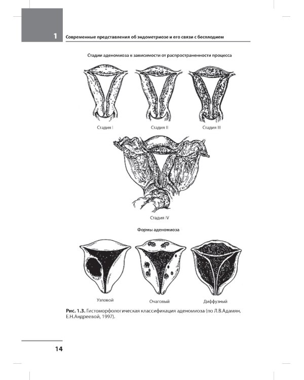 Лечение бесплодия при эндометриозе: взгляд репродуктолога