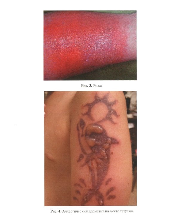 Сестринская помощь в дерматологии и венерологии: Учебник для медицинских училищ и колледжей. 2-е изд., перераб. и доп