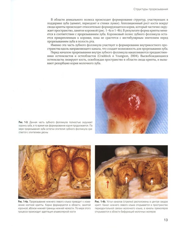 Хирургическое и ортодонтическое лечение ретинированных зубов